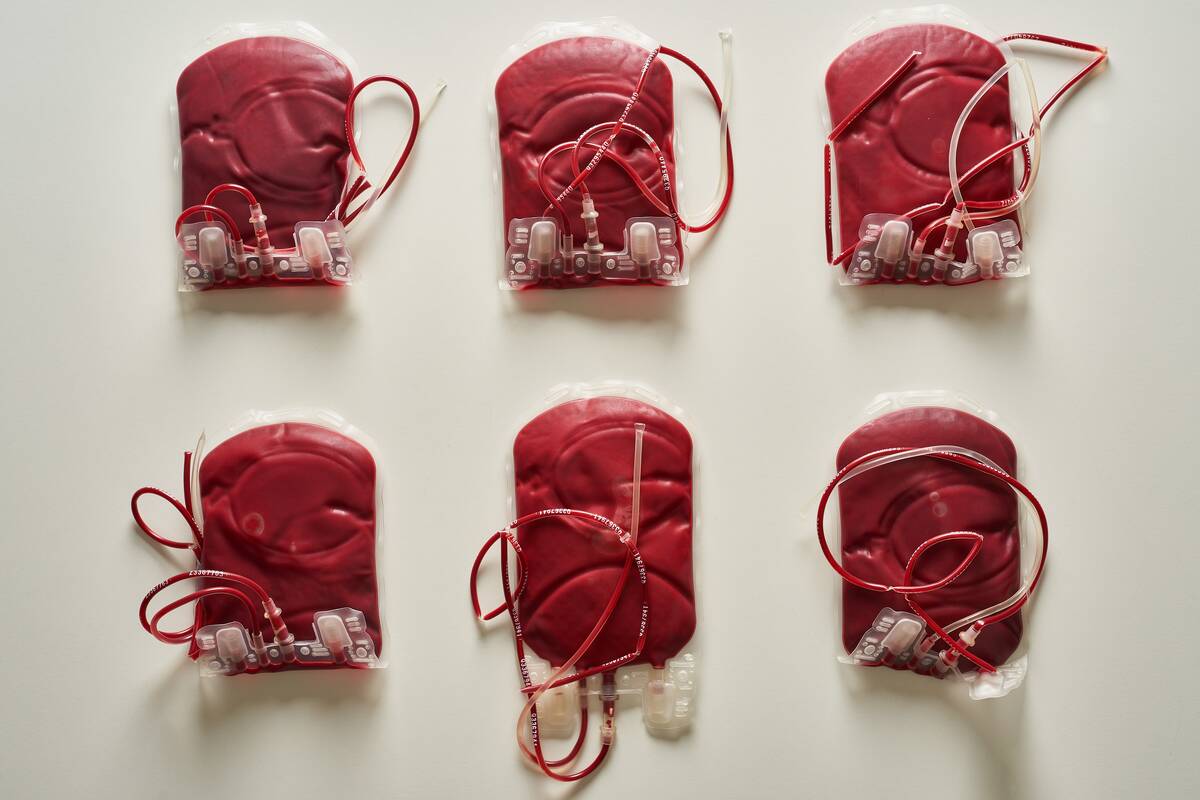 Frozen plasma. HAR &Eacute;cija, Seville. APESBG